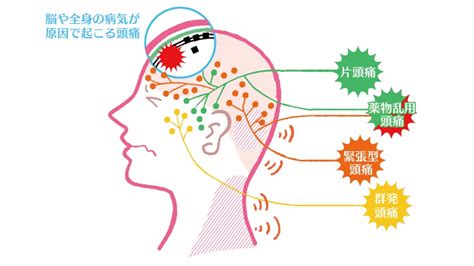 起床偏頭痛|頭痛の要因1位は、「気圧の変化」～気象からヘルスケアを考える